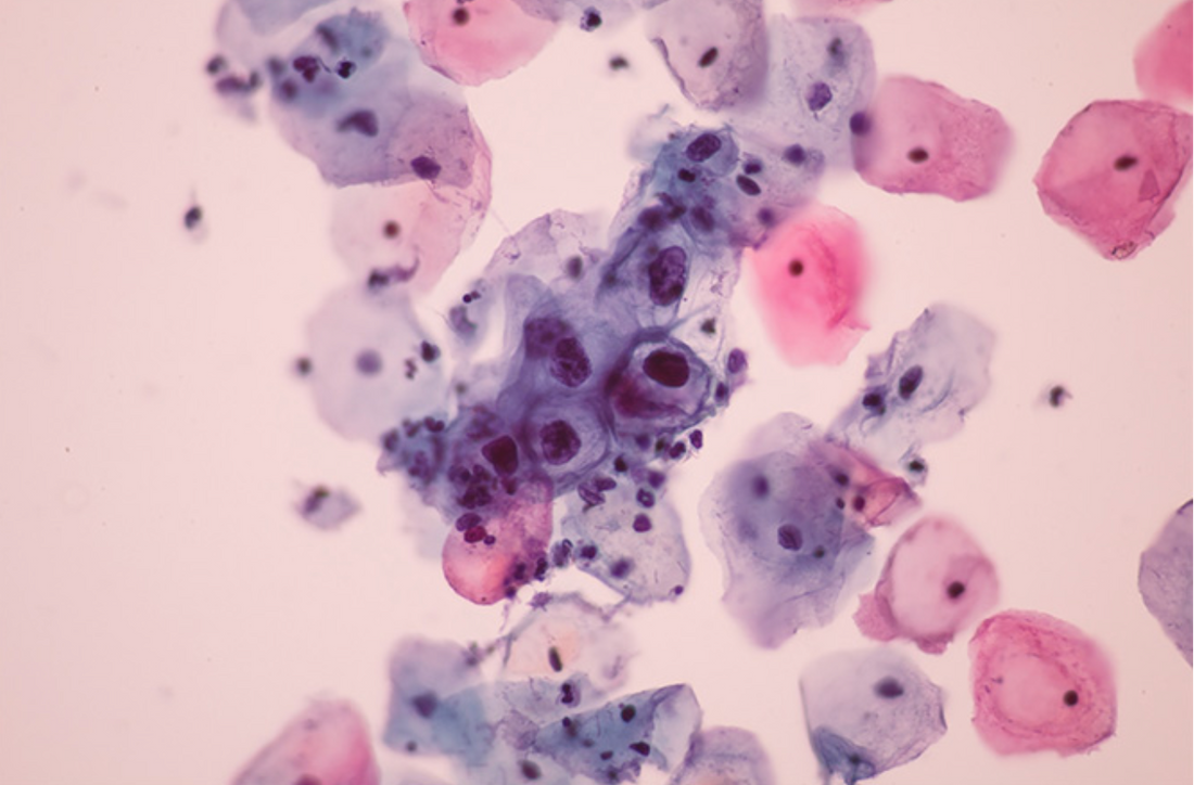 Cervical Dysplasia, HPV, Warts