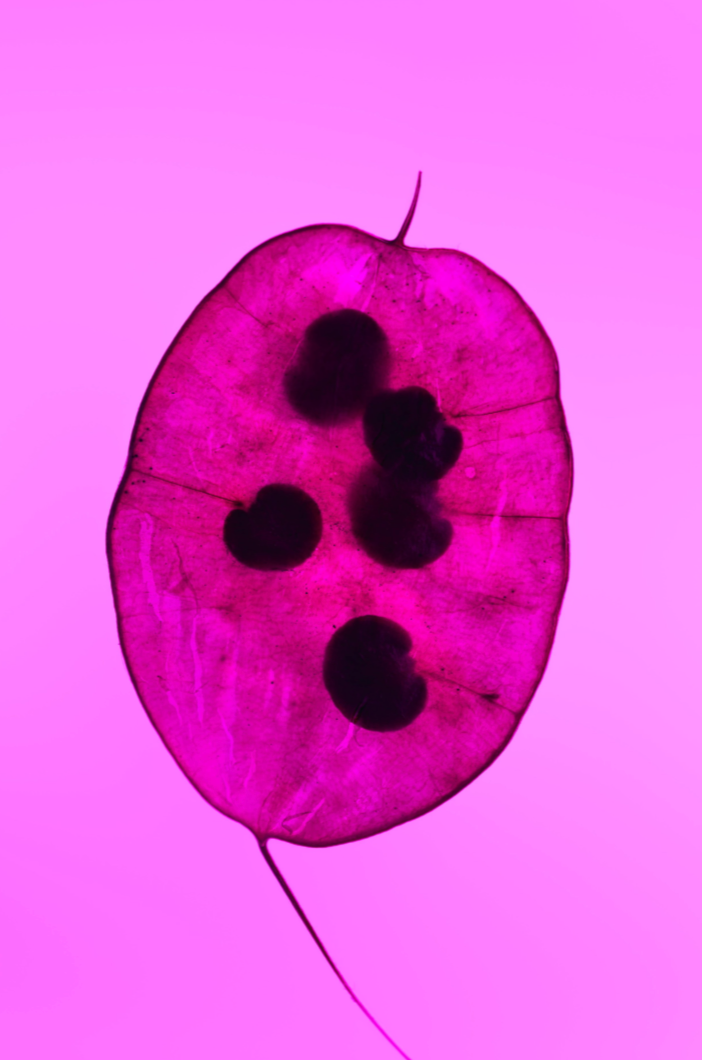 Untreated CIN 2 and subsequent risk of cervical cancer: population based cohort study