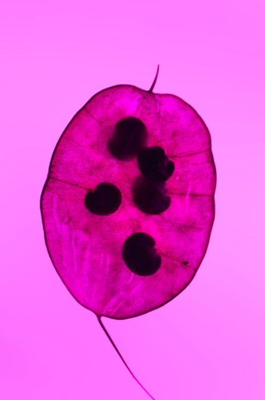 Untreated CIN 2 and subsequent risk of cervical cancer: population based cohort study