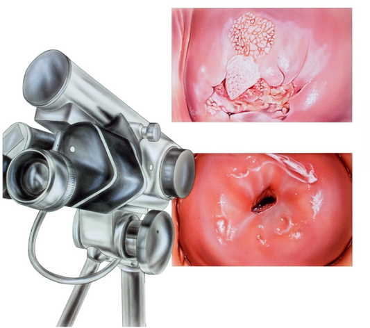 Detection of cervical high-grade squamous intraepithelial lesions and assessing diagnostic performance of colposcopy among women with oncogenic HPV