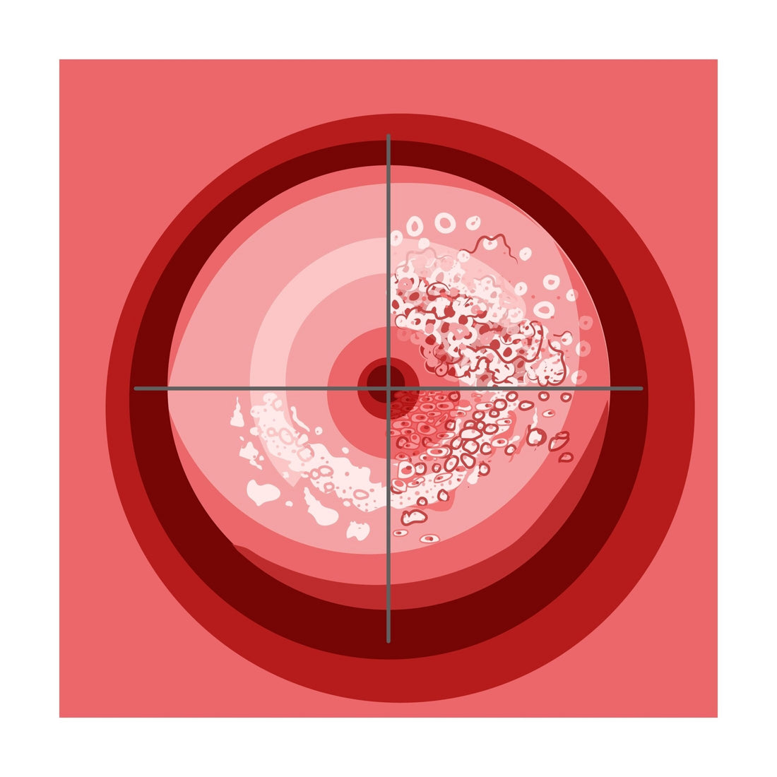 What is cervical dysplasia, anyway?